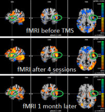 fMRI images of a brain before and after TMS.