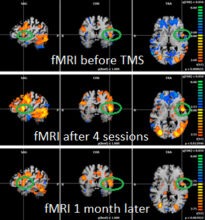FMRI e1676554164716